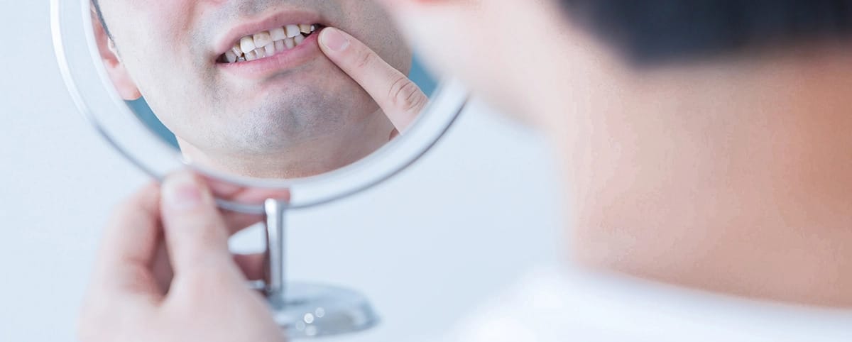 Person betrachtet Zähne im Spiegel, Fokus auf Lächeln mit ungleichmäßigen Zähnen; Thema ästhetische Zahnheilkunde.