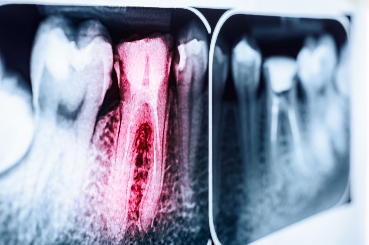 endodontie