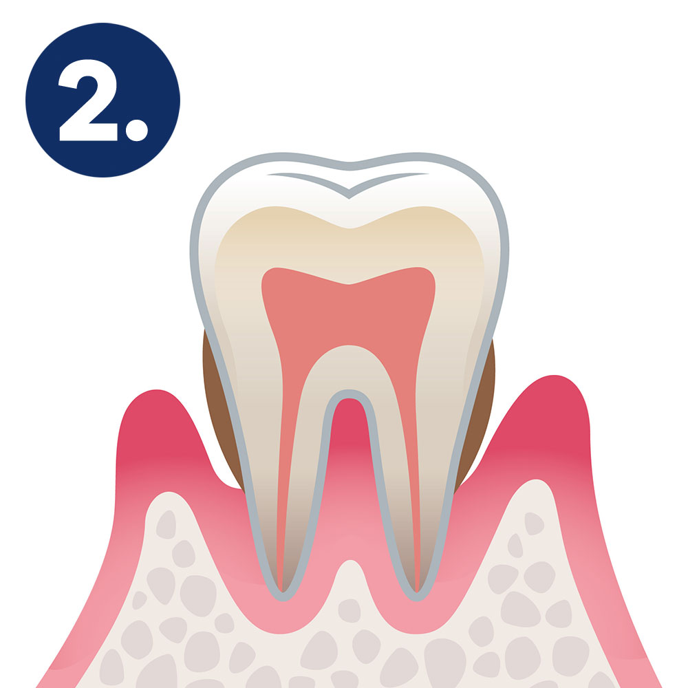 Phase 2. Illustration einer frühen Phase der Parodontitis mit Zahnaufbau und beginnender Zahnfleischentzündung.